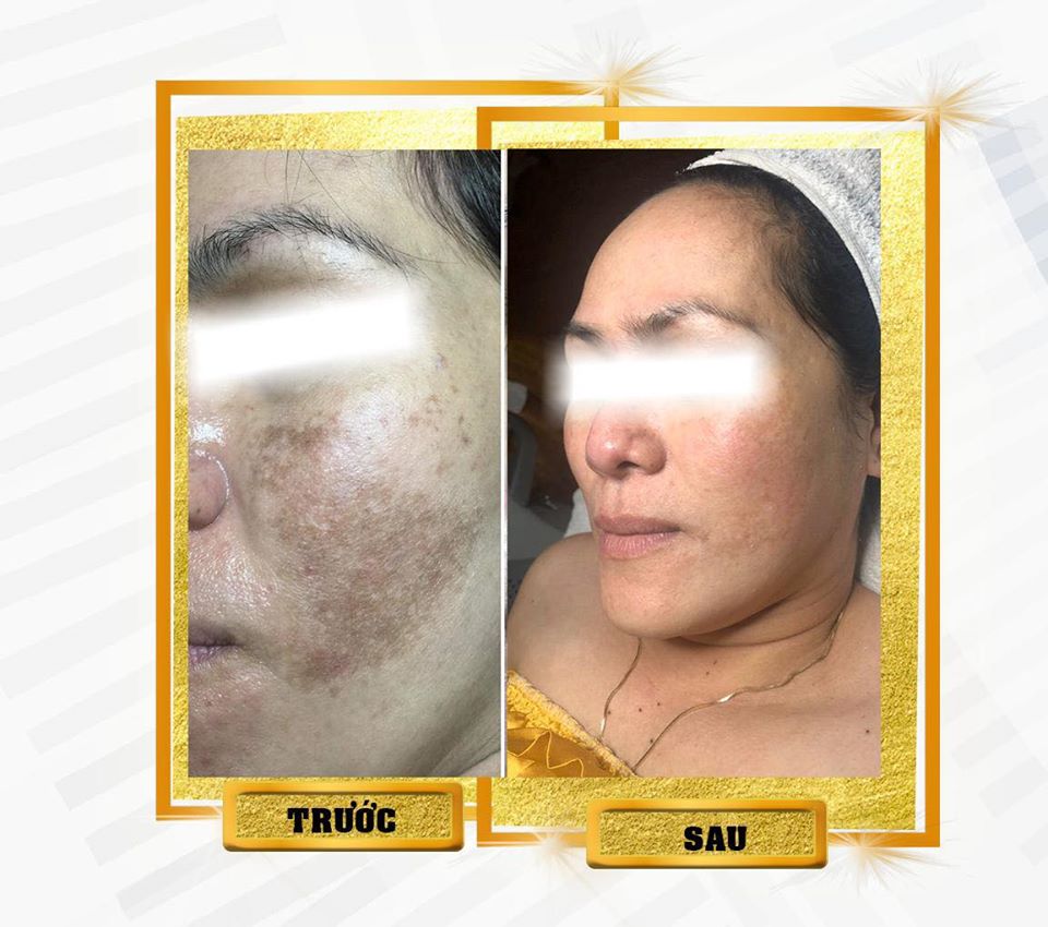 Điều trị nám da mặt tại Thu Minh Beauty - hiệu quả 99%